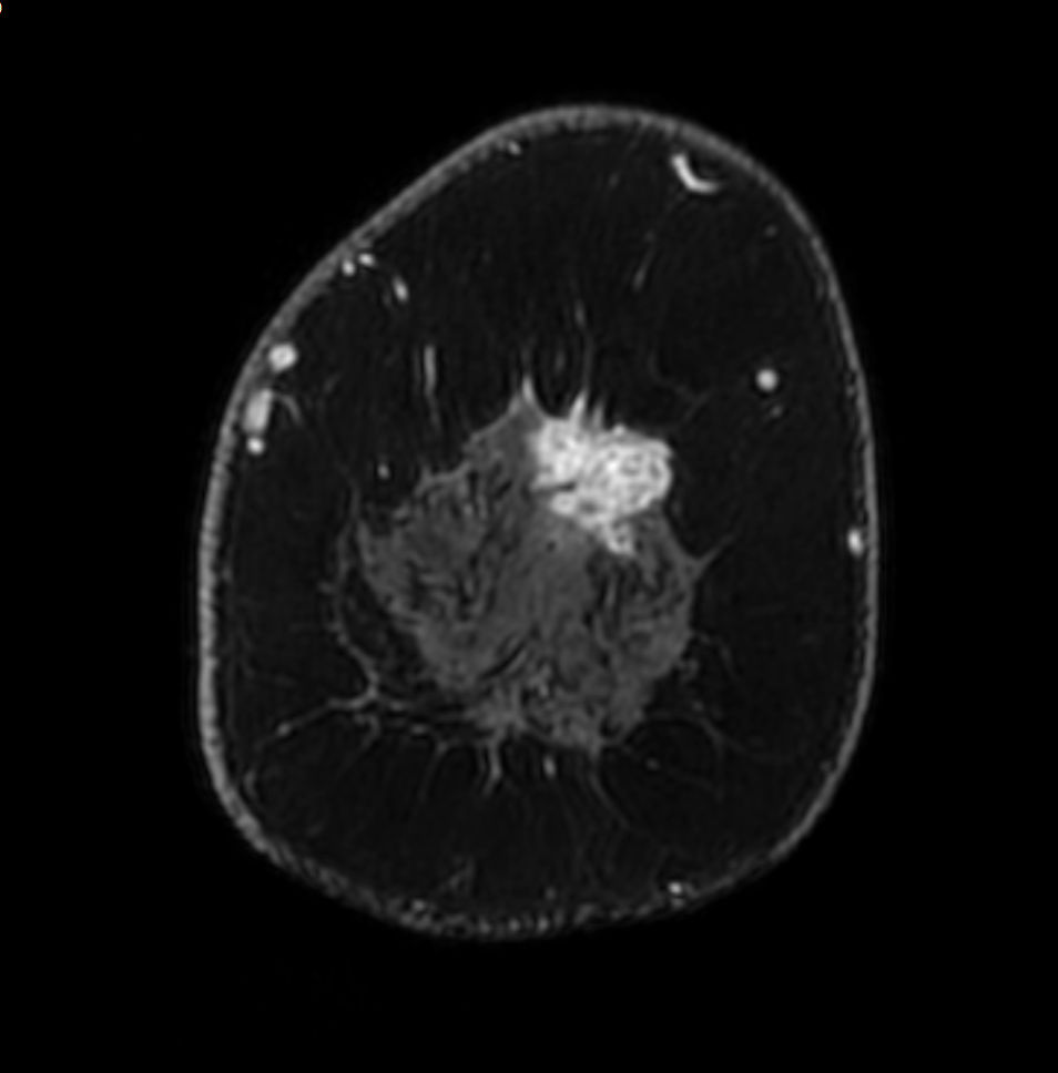 3D mDIXON XD +gado (right breast, reformat) <b>Compressed SENSE</b>