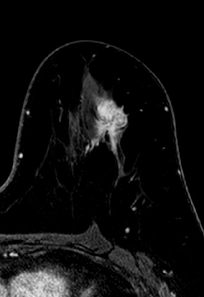 3D mDIXON XD +gado (right breast, reformat) <b>Compressed SENSE</b>