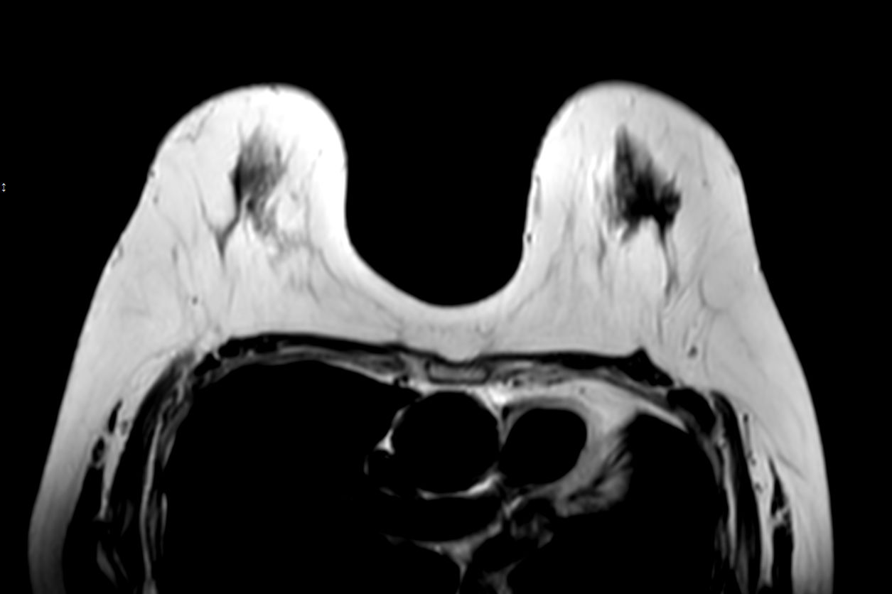 T2w TSE (single shot)