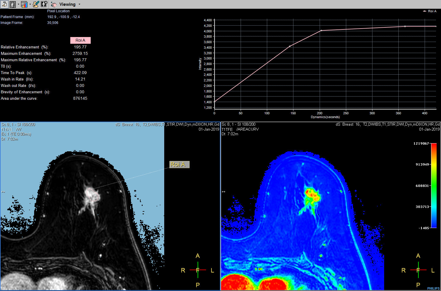 Dynamic 3D mDIXON XD - Post processing <b>Compressed SENSE</b>