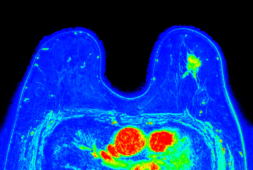 Dynamic 3D mDIXON XD (maximum enhancement) <b>Compressed SENSE</b>