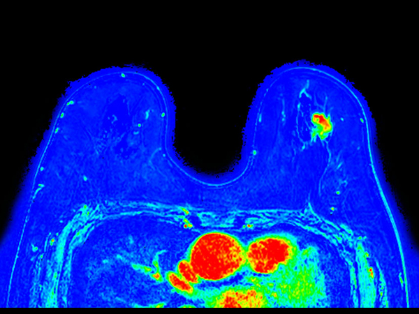 Dynamic 3D mDIXON XD (are under curve) <b>Compressed SENSE</b>