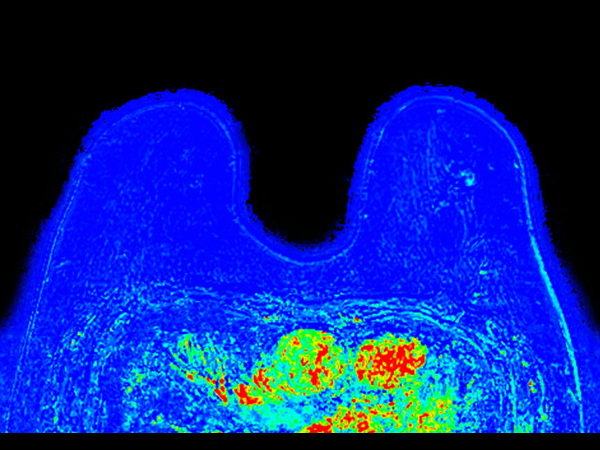 Dynamic 3D mDIXON XD (washout) <b>Compressed SENSE</b>