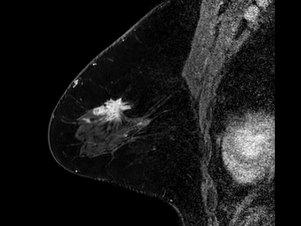 3D mDIXON XD +gado (right breast) <b>Compressed SENSE</b>