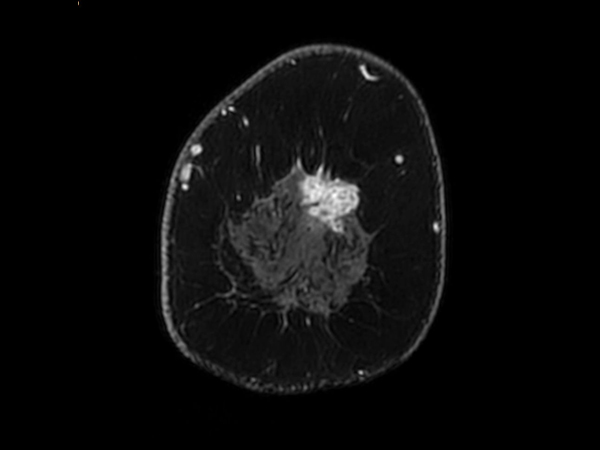 3D mDIXON XD +gado (right breast, reformat) <b>Compressed SENSE</b>