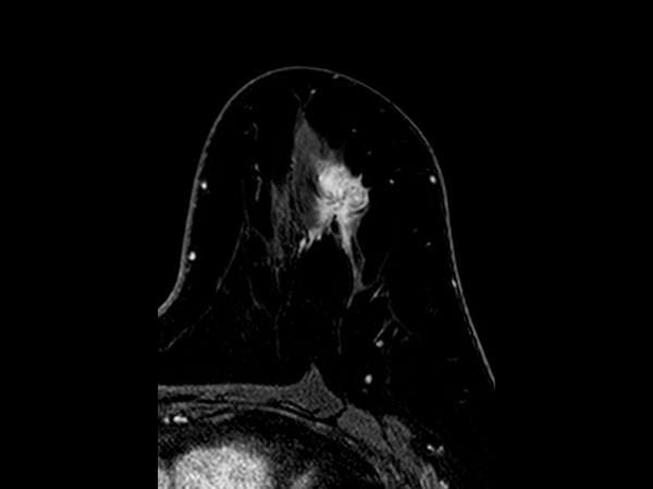 3D mDIXON XD +gado (right breast, reformat) <b>Compressed SENSE</b>