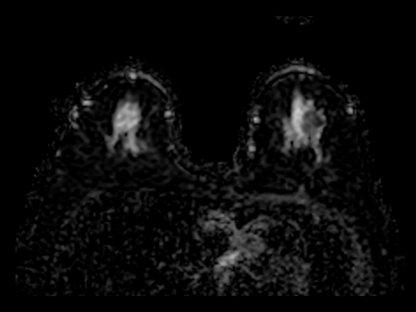 Diffusion (ADC)