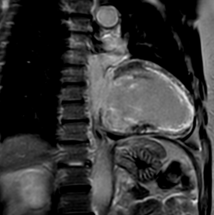 2 chamber view 3D PSIR