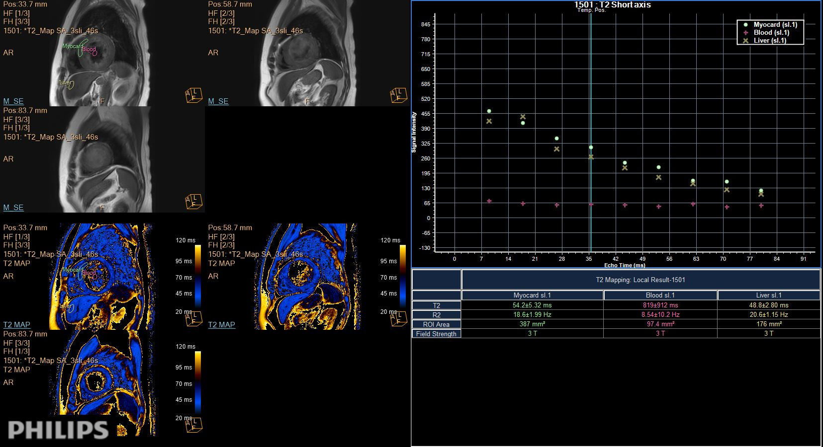 Short axis view (T2 Mapping on ISP 12)