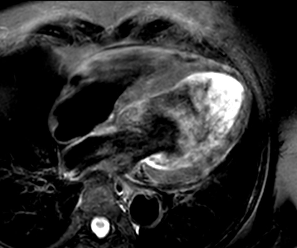 4 chamber view T2w Black Blood