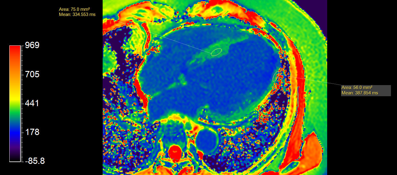 4 chamber view T1 Map (enhanced)