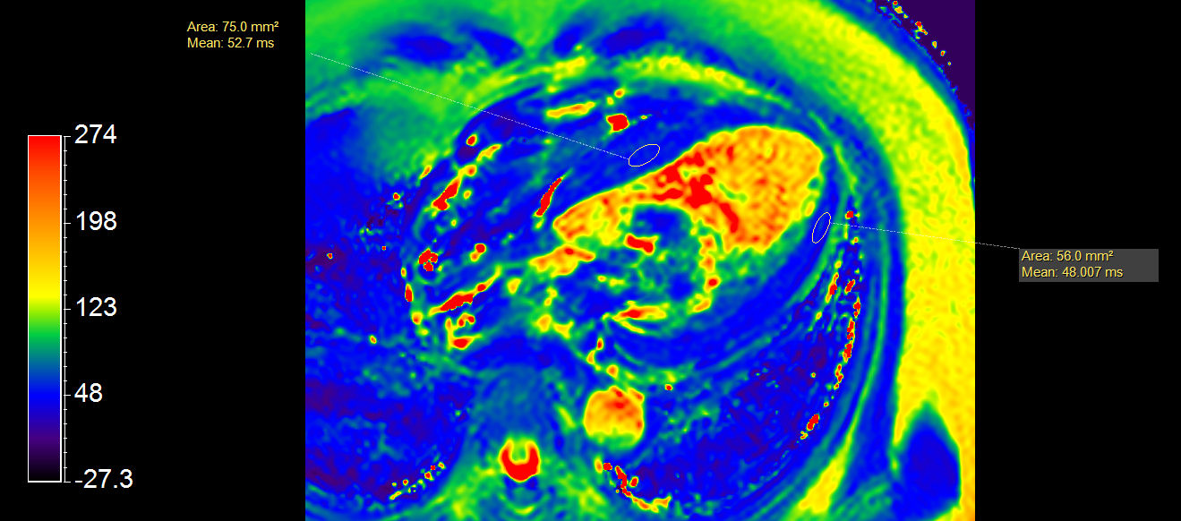 4 chamber view T2 Map 