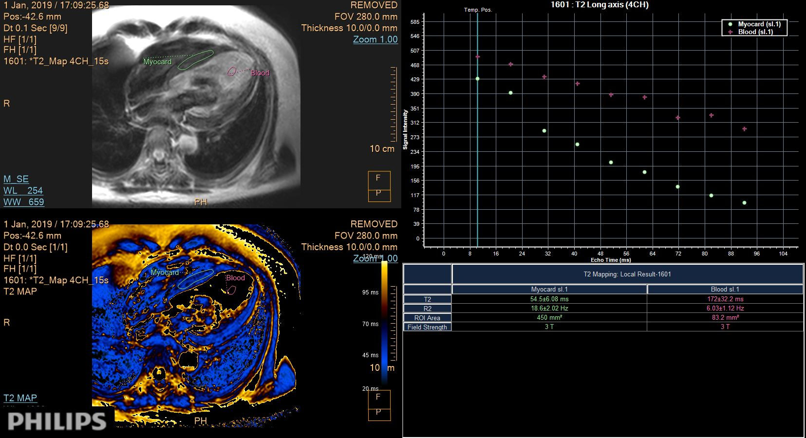 4 chamber view (T2 Mapping on ISP 12)