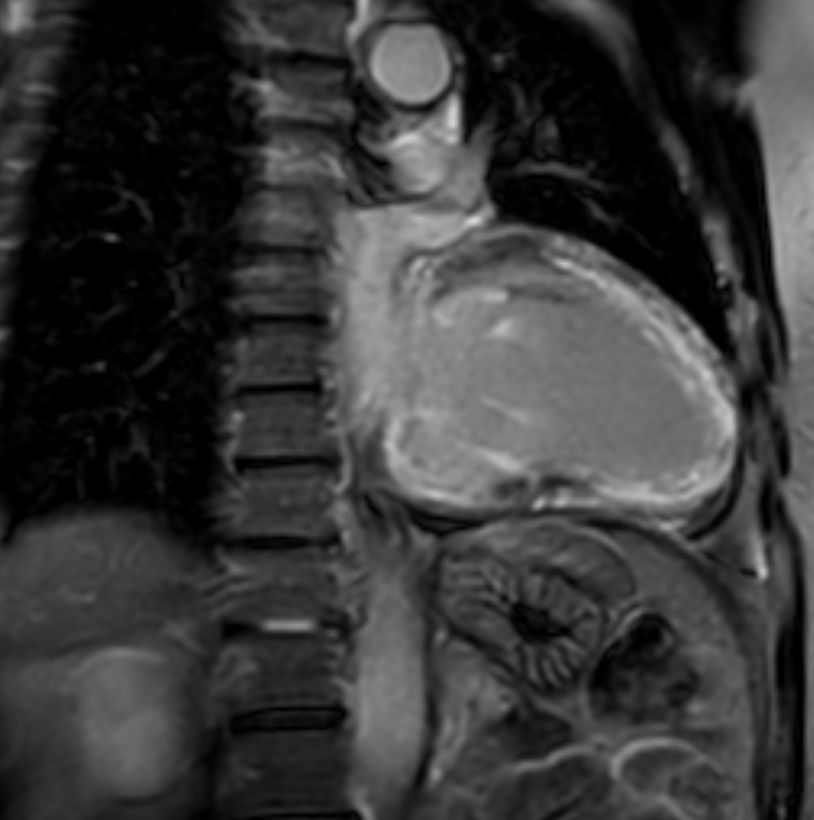 2 chamber view 3D Late Gadolinium Enhancement