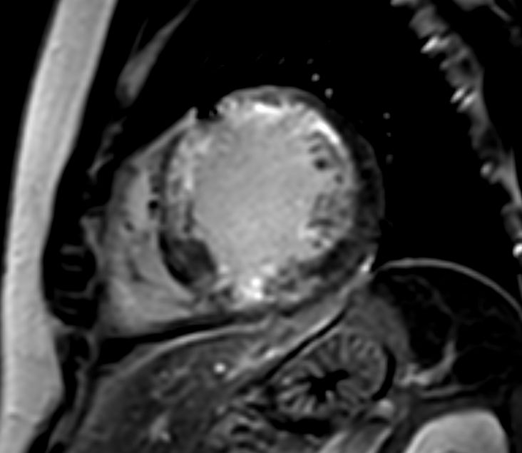 Short axis view 3D Late Gadolinium Enhancement