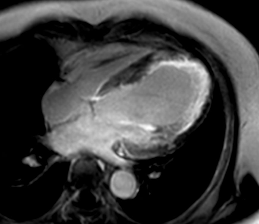 4 chamber view 3D Late Gadolinium Enhancement