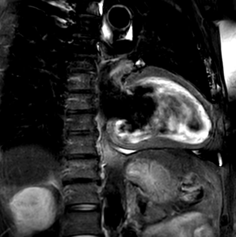 2 chamber view T2w Black Blood