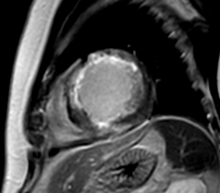 Short axis view 3D PSIR 