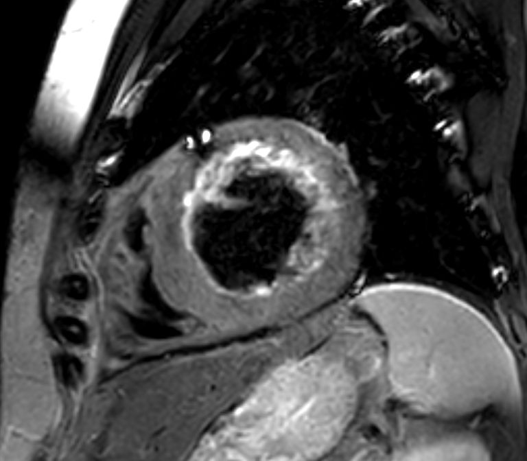 Short axis view T2w Black Blood