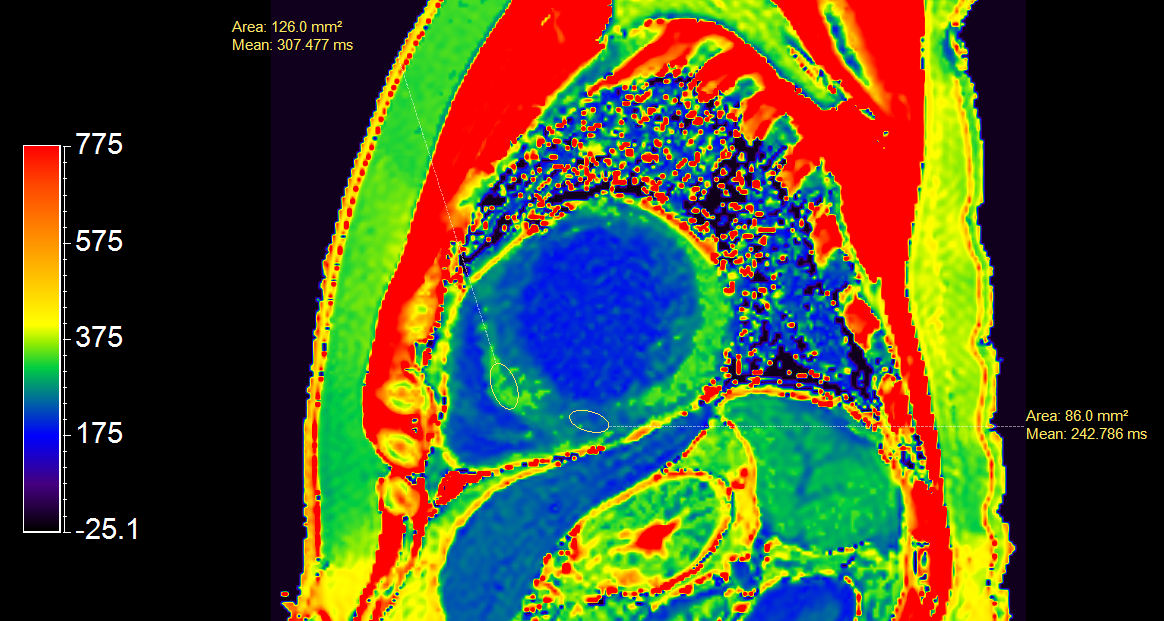 Short axis view T1 Map (enhanced)
