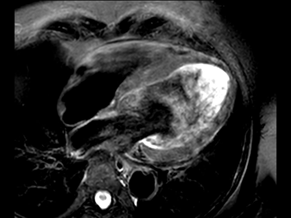 4 chamber view T2w Black Blood