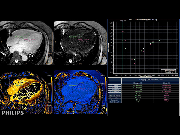 4 chamber view (T1 Mapping on ISP 12)