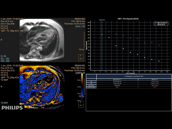 4 chamber view (T2 Mapping on ISP 12)