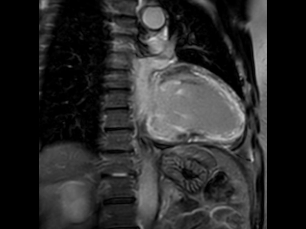 2 chamber view 3D Late Gadolinium Enhancement