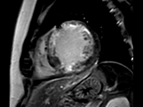 Short axis view 3D Late Gadolinium Enhancement