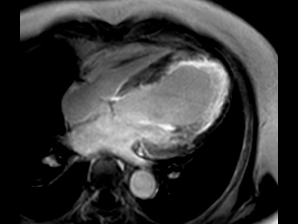 4 chamber view 3D Late Gadolinium Enhancement