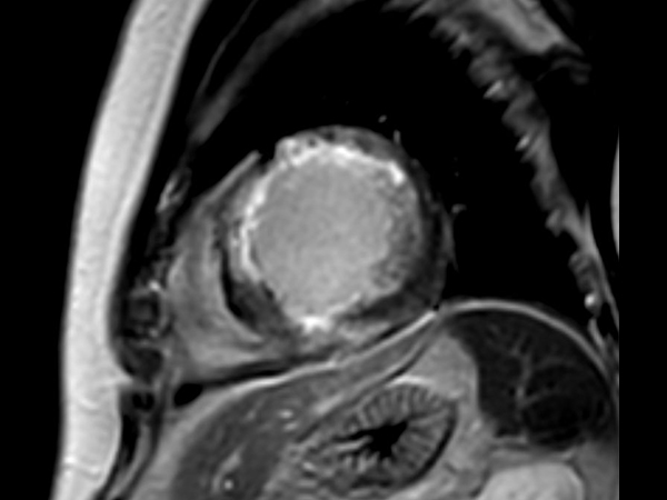 Short axis view 3D PSIR 