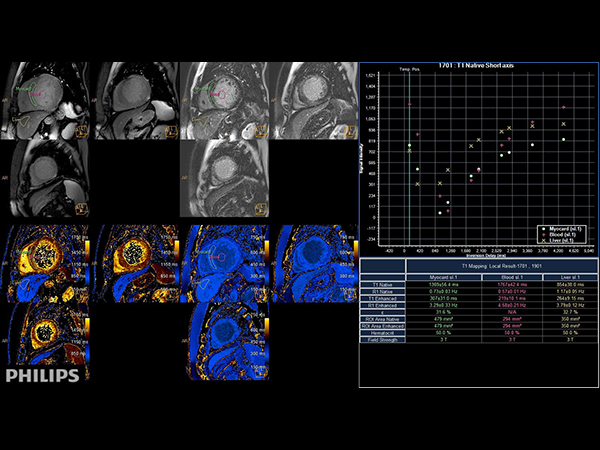 Short axis view (T1 Mapping on ISP 12)