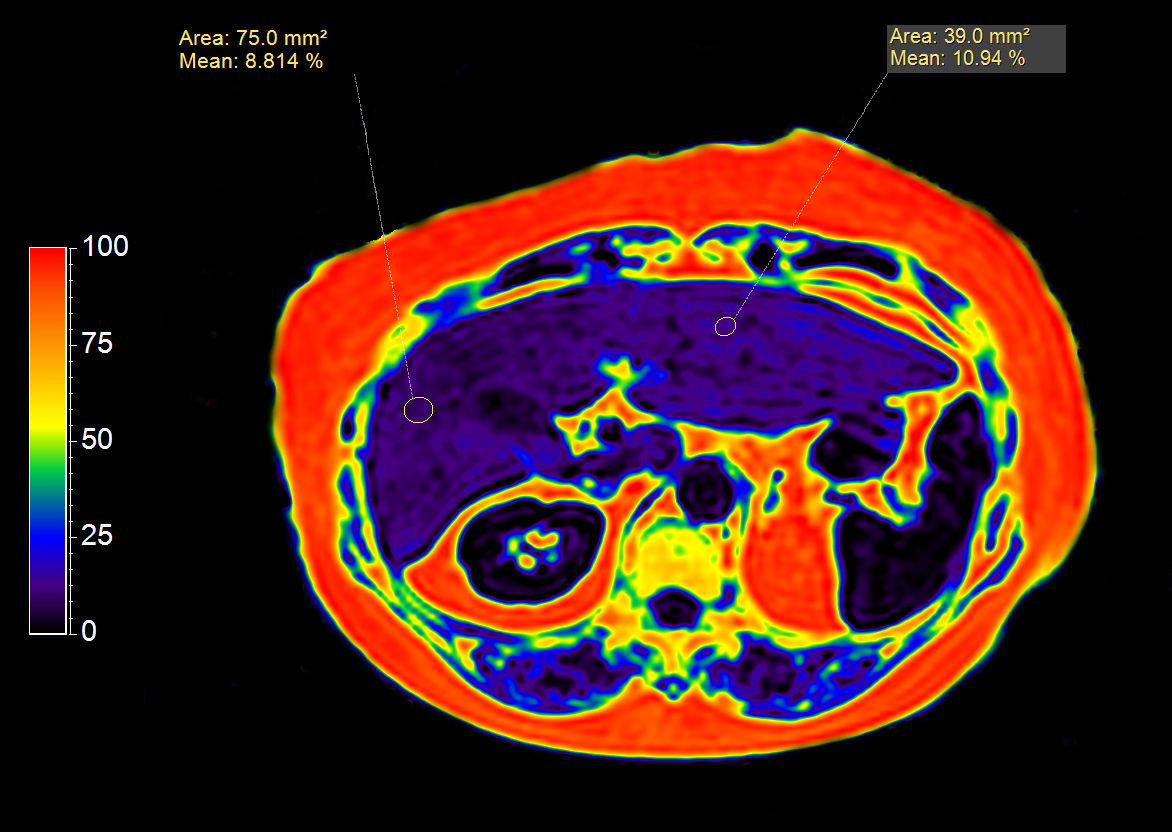 mDIXON XD Quant (Fat Fraction Map)