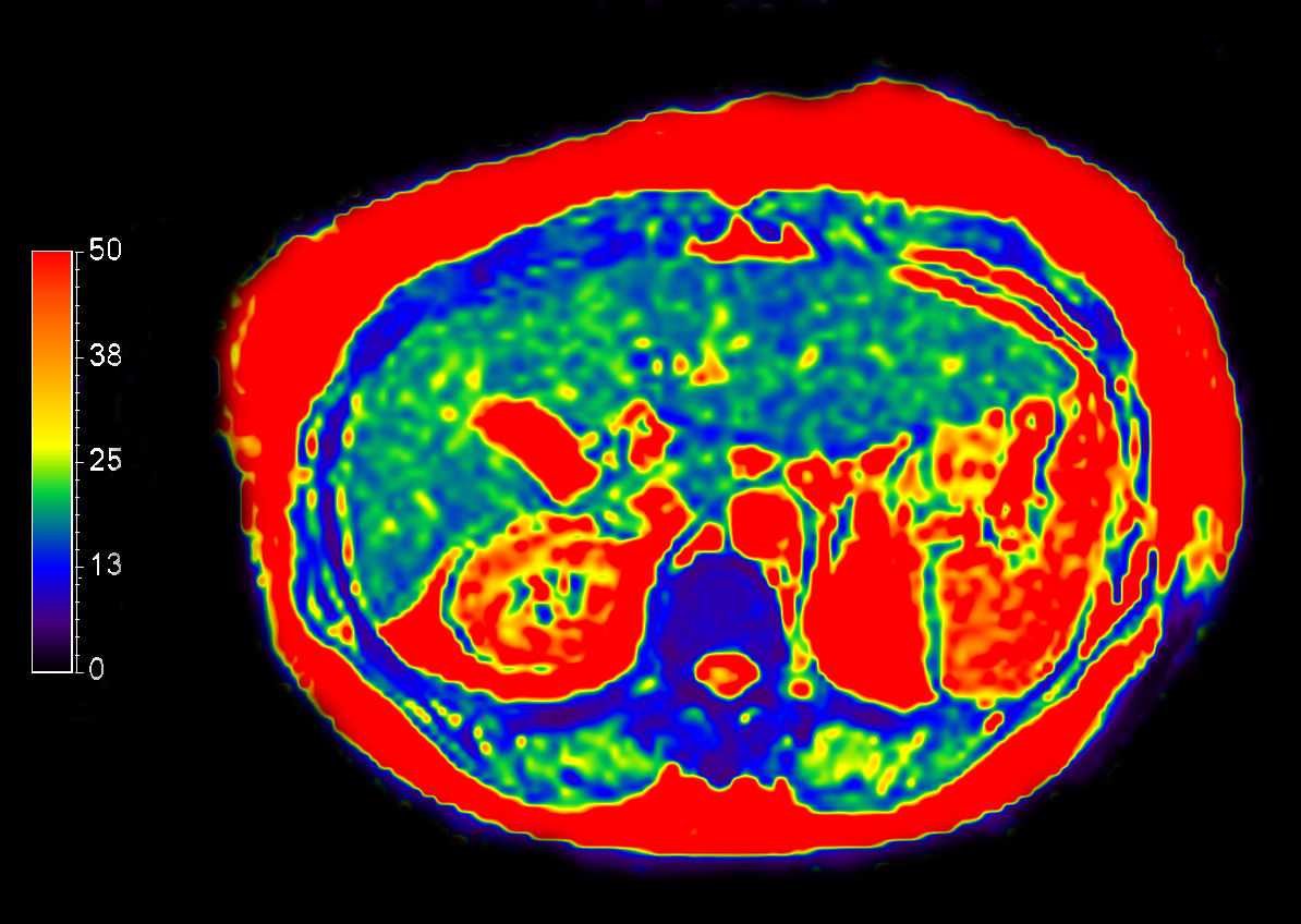 mDIXON XD Quant (T2* Map)