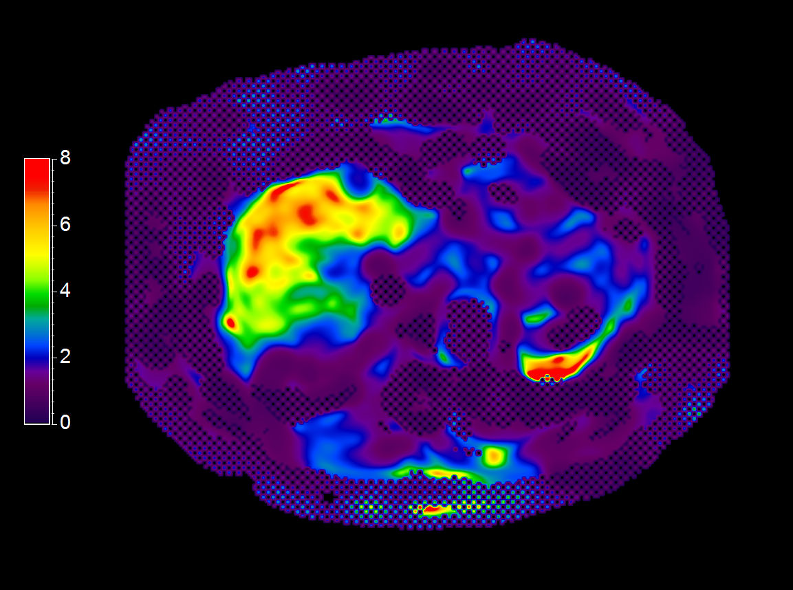 MR Elastography (SE-EPI, 4 slices) (Stiffness Map)