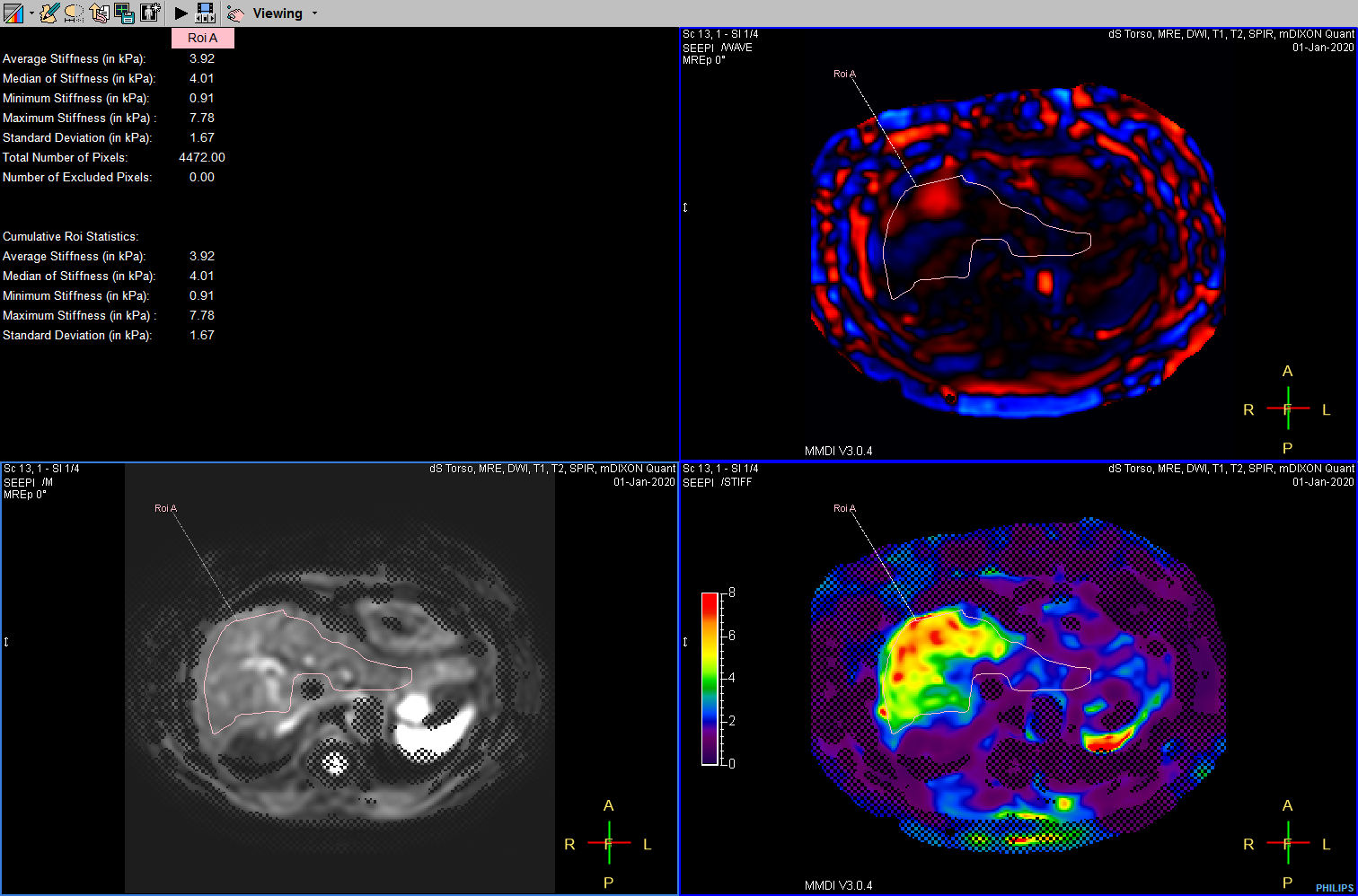MR Elastography (SE-EPI, 4 slices) (processing)