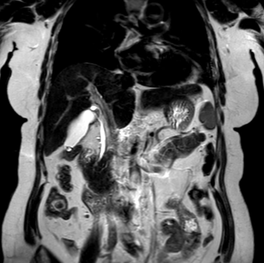 T2w TSE (single shot)