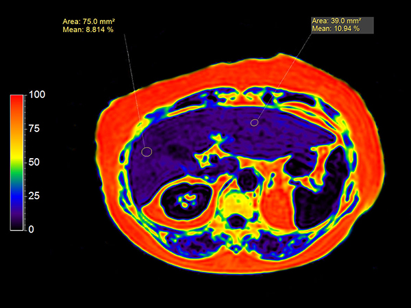 mDIXON XD Quant (Fat Fraction Map)