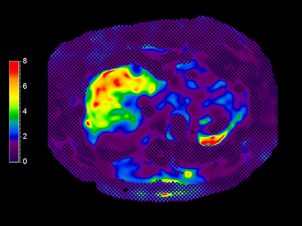 MR Elastography (SE-EPI, 4 slices) (Stiffness Map)