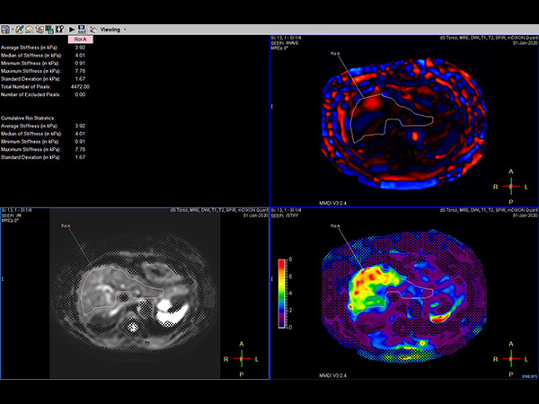 MR Elastography (SE-EPI, 4 slices) (processing)