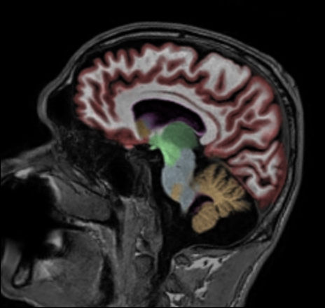 Sagittal 3D T1w TFE with NeuroQuant segmentation
