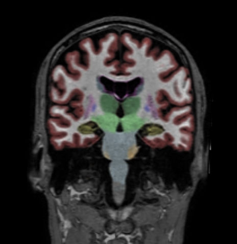 Coronal reformat 3D T1w TFE with NeuroQuant segmentation