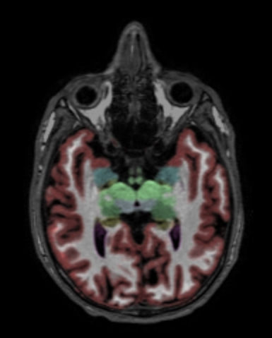 Axial reformat 3D T1w TFE with NeuroQuant segmentation