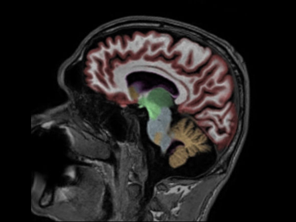 Sagittal 3D T1w TFE with NeuroQuant segmentation