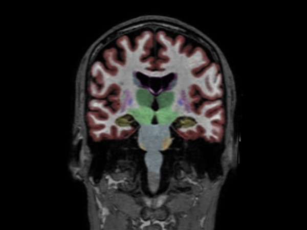 Coronal reformat 3D T1w TFE with NeuroQuant segmentation