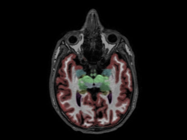 Axial reformat 3D T1w TFE with NeuroQuant segmentation