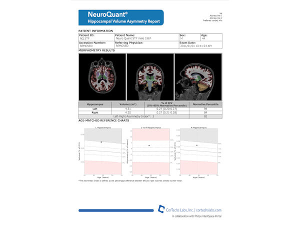 NeuroQuant - Hippocampal volume and asymmetry report