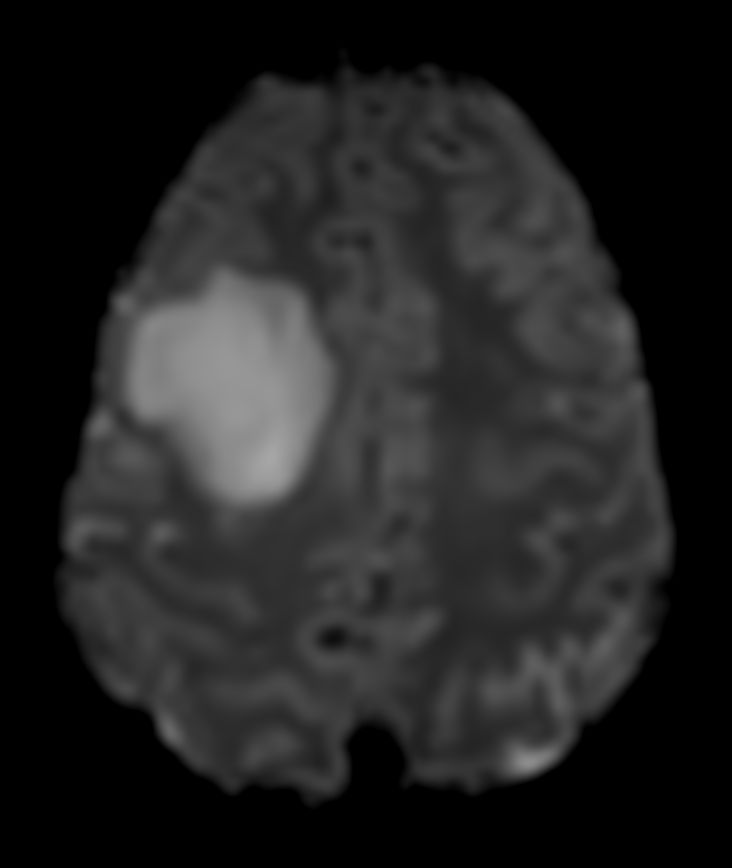 T2* Perfusion (FFE-EPI)