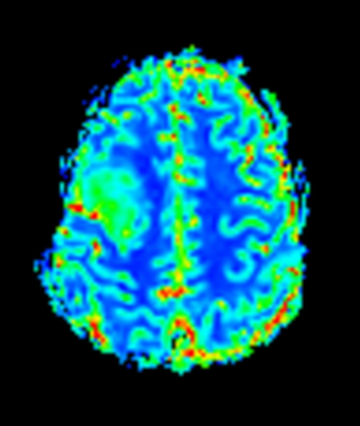 T2* Perfusion (Cerebral Blood Volume)