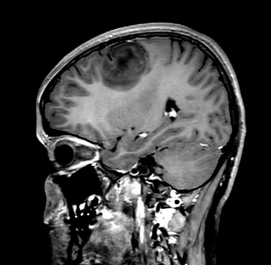 Sagittal 3D T1w TSE +gado <b>Compressed SENSE</b>